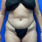 Tummy Tuck Before & After Patient #9933