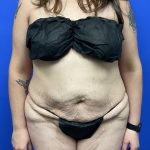 Tummy Tuck Before & After Patient #9931