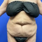 Tummy Tuck Before & After Patient #9937