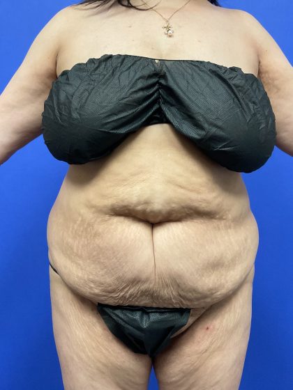 Tummy Tuck Before & After Patient #9937