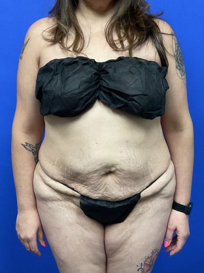Tummy Tuck Before & After Patient #9931