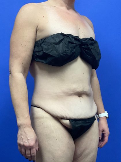 Tummy Tuck Before & After Patient #9932
