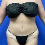 Tummy Tuck Before & After Patient #9933