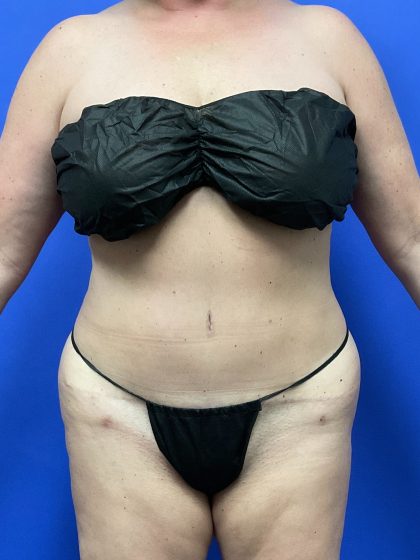Tummy Tuck Before & After Patient #9933