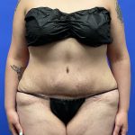 Tummy Tuck Before & After Patient #9931
