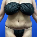 Tummy Tuck Before & After Patient #9937