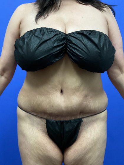 Tummy Tuck Before & After Patient #9937