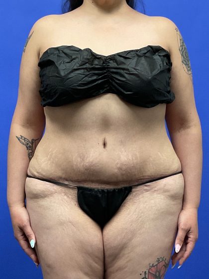 Tummy Tuck Before & After Patient #9931