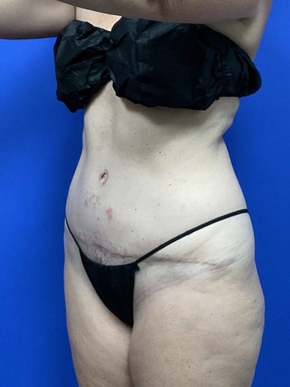 Tummy Tuck Before & After Patient #9934