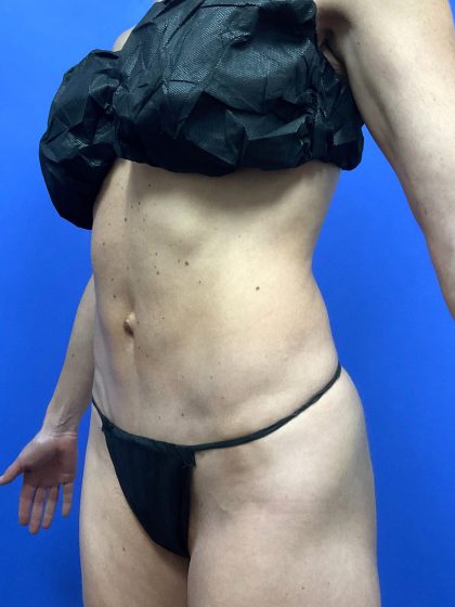 Tummy Tuck Before & After Patient #9938