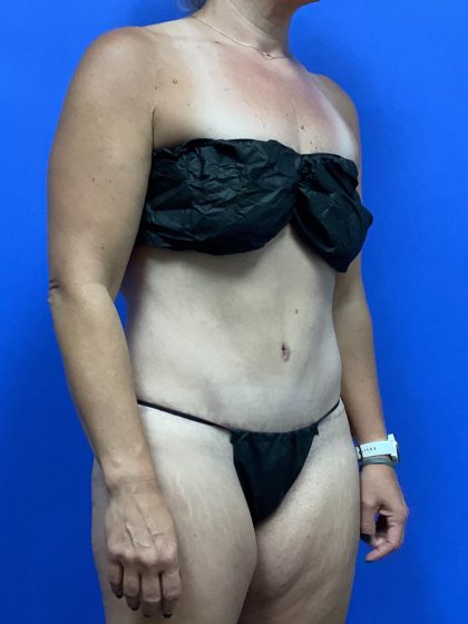 Tummy Tuck Before & After Patient #9932