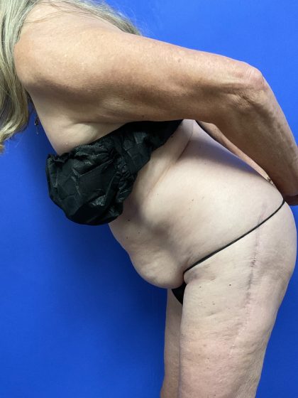 Tummy Tuck Before & After Patient #9936