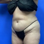 Tummy Tuck Before & After Patient #9933