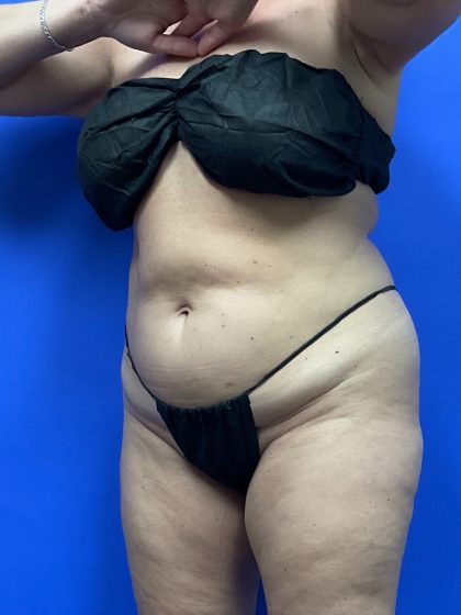Tummy Tuck Before & After Patient #9933