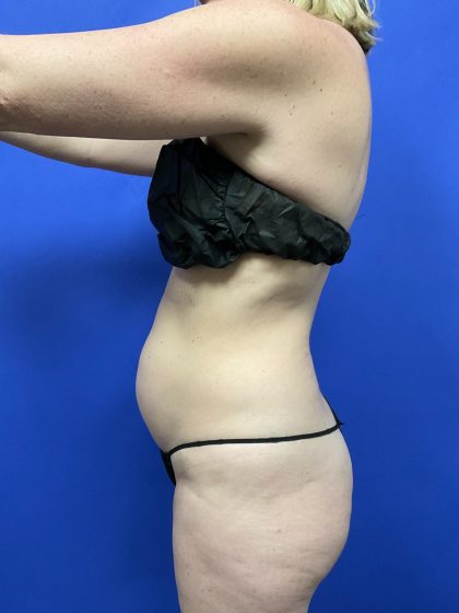 Tummy Tuck Before & After Patient #9934