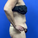 Tummy Tuck Before & After Patient #9932