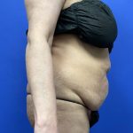 Tummy Tuck Before & After Patient #9937