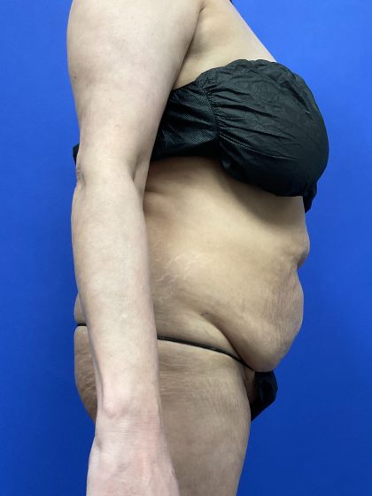 Tummy Tuck Before & After Patient #9937