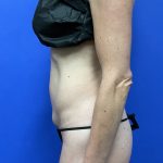 Tummy Tuck Before & After Patient #9938