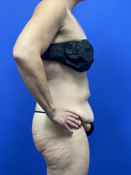 Tummy Tuck Before & After Patient #9932
