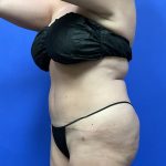 Tummy Tuck Before & After Patient #9933