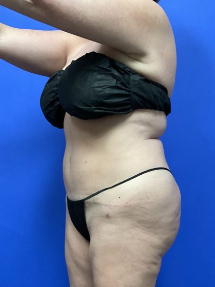 Tummy Tuck Before & After Patient #9933