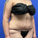 Tummy Tuck Before & After Patient #9931