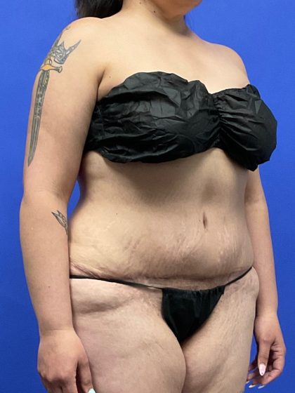 Tummy Tuck Before & After Patient #9931