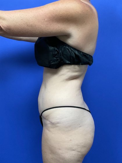 Tummy Tuck Before & After Patient #9934