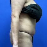 Tummy Tuck Before & After Patient #9937