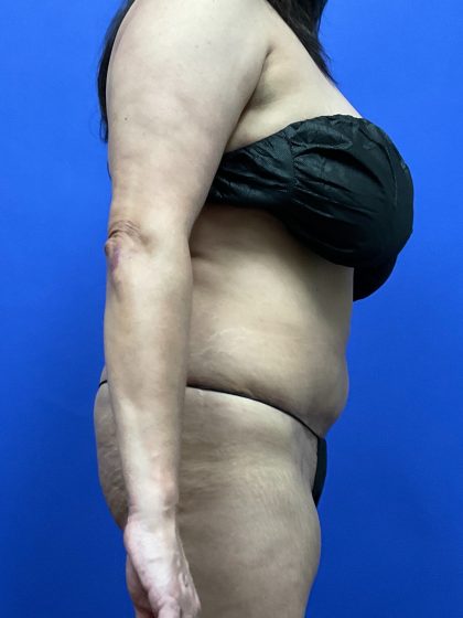 Tummy Tuck Before & After Patient #9937