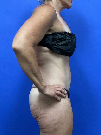 Tummy Tuck Before & After Patient #9932