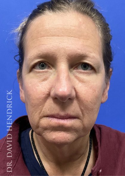 Brow Lift Before & After Patient #9983