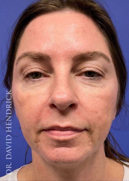 Facelift Before & After Patient #9984
