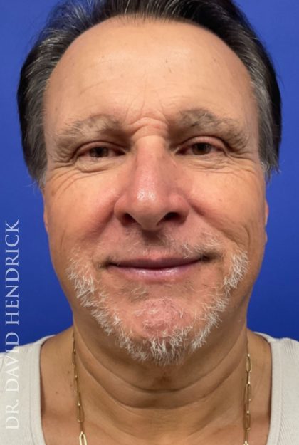 Facelift Before & After Patient #9985