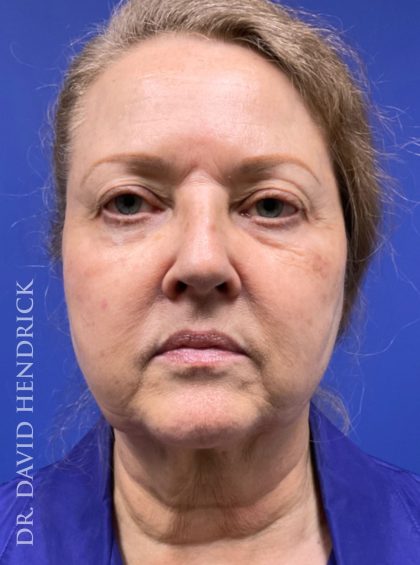 Facelift Before & After Patient #9982