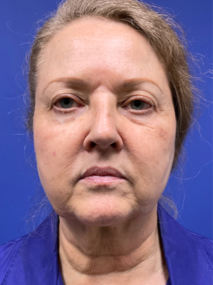 Facelift Before & After Patient #9982