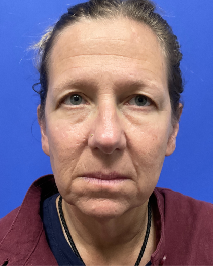 Brow Lift Before & After Patient #9983