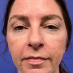 Facelift Before & After Patient #9984