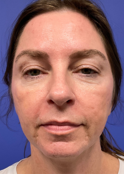 Facelift Before & After Patient #9984