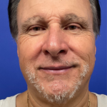 Facelift Before & After Patient #9985