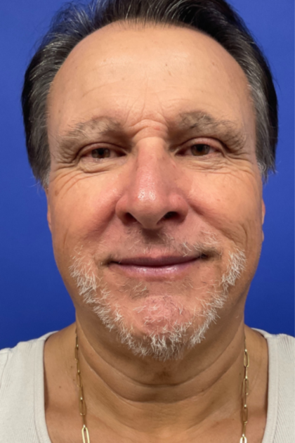 Facelift Before & After Patient #9985