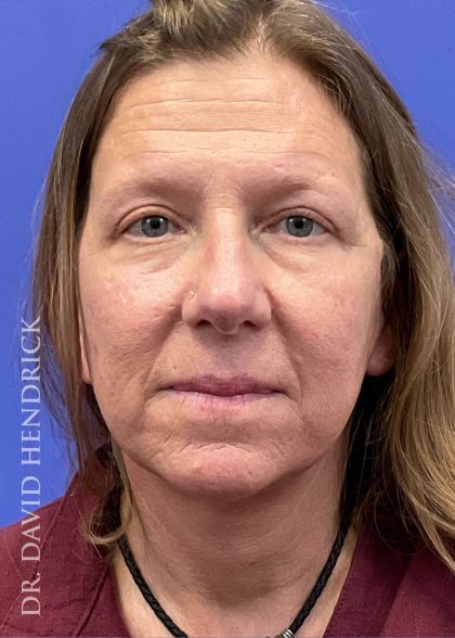 Brow Lift Before & After Patient #9983