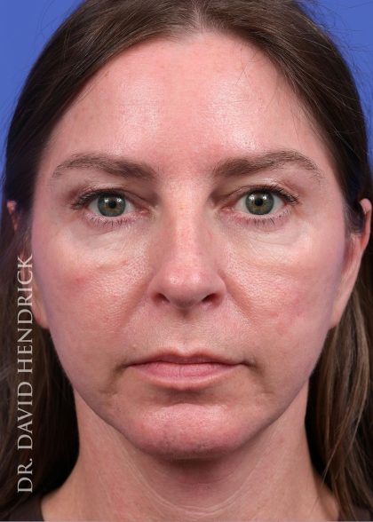 Facelift Before & After Patient #9984