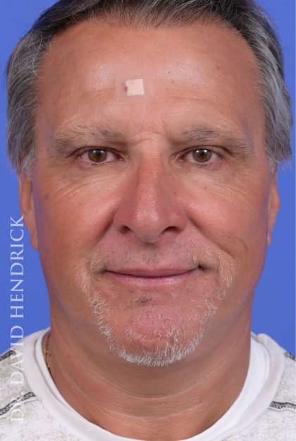 Facelift Before & After Patient #9985