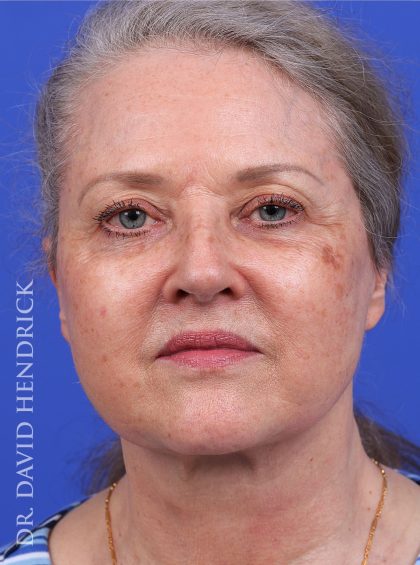 Facelift Before & After Patient #9982