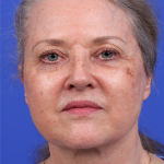 Facelift Before & After Patient #9982
