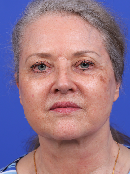Facelift Before & After Patient #9982