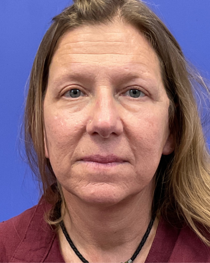 Brow Lift Before & After Patient #9983