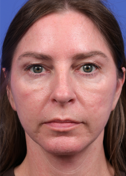 Facelift Before & After Patient #9984
